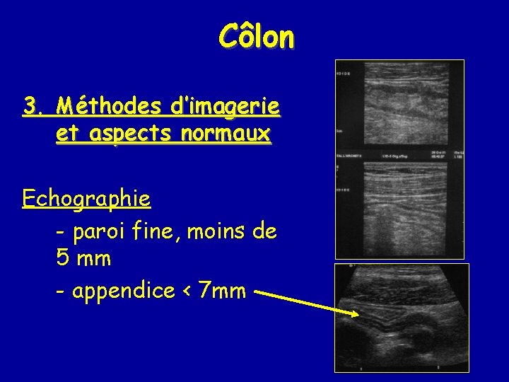 Côlon 3. Méthodes d’imagerie et aspects normaux Echographie - paroi fine, moins de 5