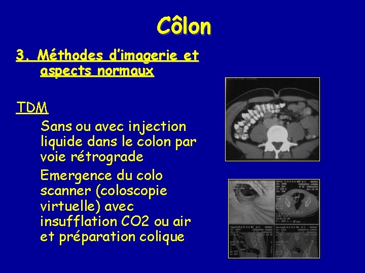 Côlon 3. Méthodes d’imagerie et aspects normaux TDM Sans ou avec injection liquide dans