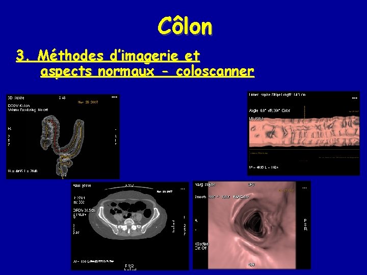 Côlon 3. Méthodes d’imagerie et aspects normaux - coloscanner 