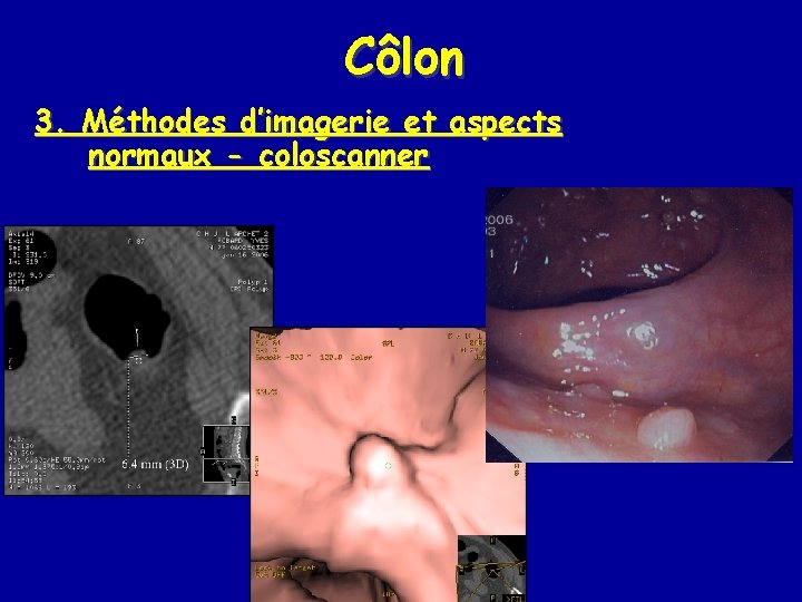 Côlon 3. Méthodes d’imagerie et aspects normaux - coloscanner 
