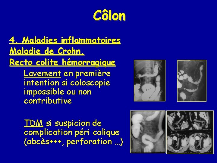 Côlon 4. Maladies inflammatoires Maladie de Crohn, Recto colite hémorragique Lavement en première intention