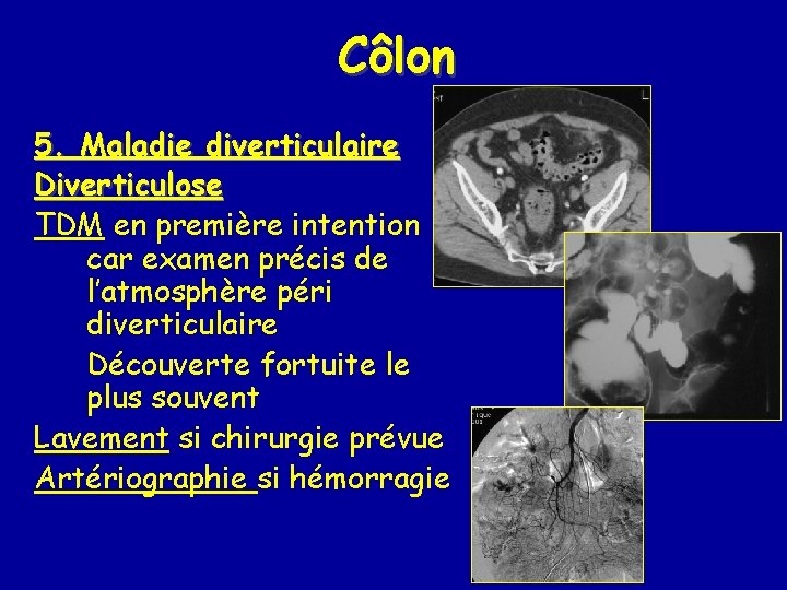 Côlon 5. Maladie diverticulaire Diverticulose TDM en première intention car examen précis de l’atmosphère