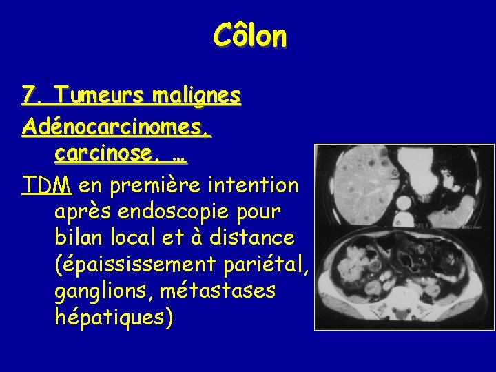 Côlon 7. Tumeurs malignes Adénocarcinomes, carcinose, … TDM en première intention après endoscopie pour
