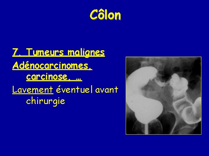 Côlon 7. Tumeurs malignes Adénocarcinomes, carcinose, … Lavement éventuel avant chirurgie 