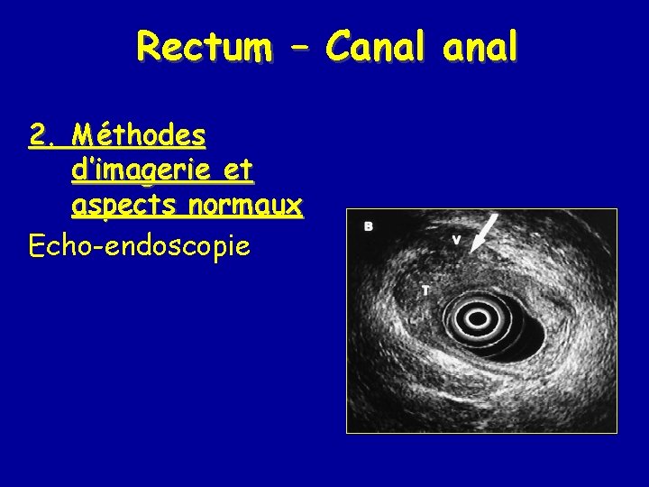 Rectum – Canal 2. Méthodes d’imagerie et aspects normaux Echo-endoscopie 