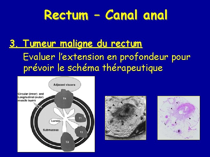 Rectum – Canal 3. Tumeur maligne du rectum Evaluer l’extension en profondeur pour prévoir