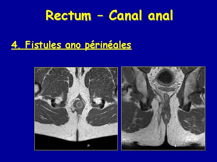 Rectum – Canal 4. Fistules ano périnéales 