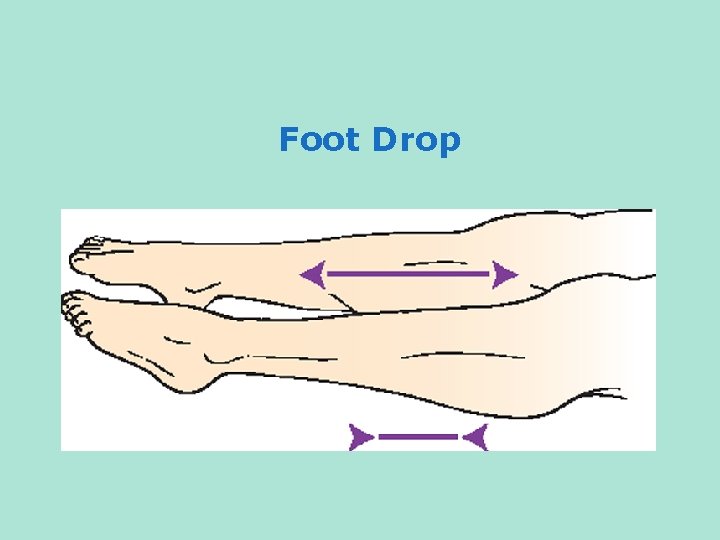 Foot Drop 