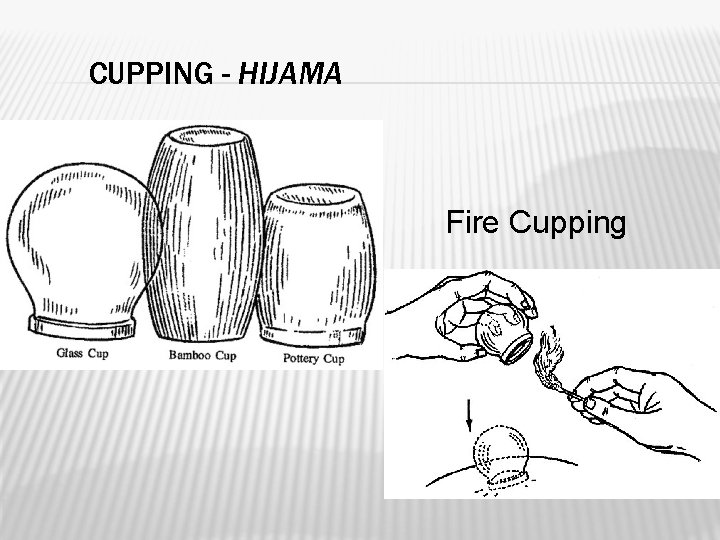 BASIC PRINCIPLES OF CUPPING THERAPY Prof Zaki Anwar