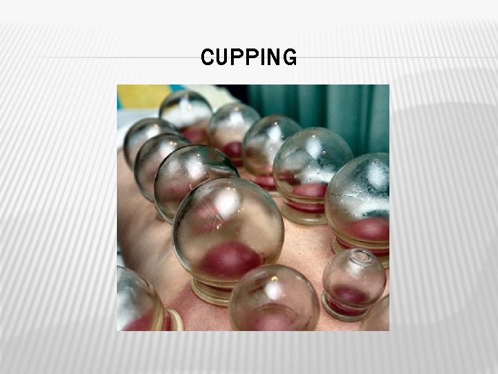 CUPPING 