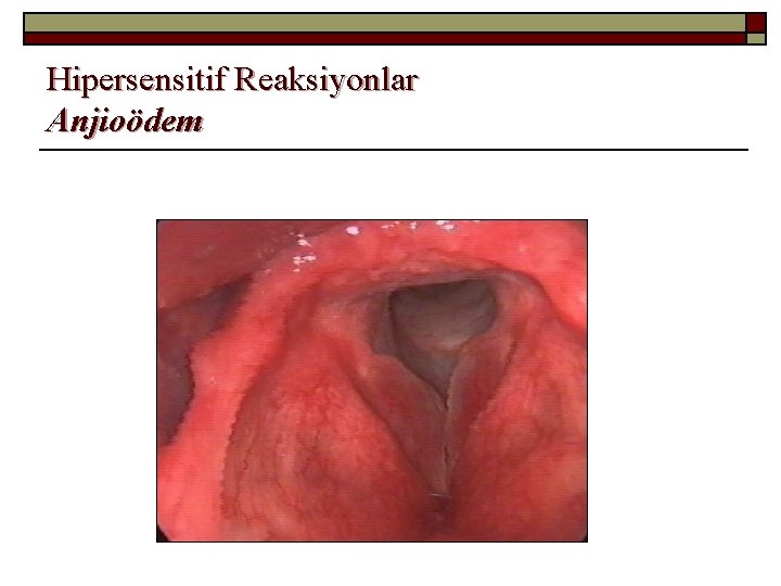 Hipersensitif Reaksiyonlar Anjioödem 