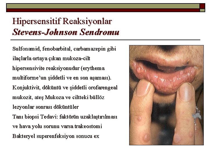 Hipersensitif Reaksiyonlar Stevens-Johnson Sendromu Sulfonamid, fenobarbital, carbamazepin gibi ilaçlarla ortaya çıkan mukoza-cilt hipersensivite reaksiyonudur