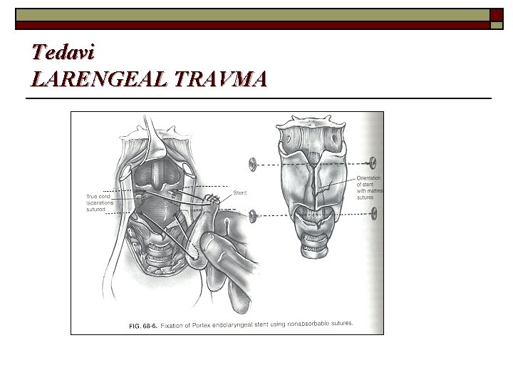 Tedavi LARENGEAL TRAVMA 