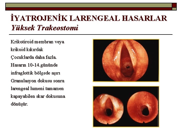 İYATROJENİK LARENGEAL HASARLAR Yüksek Trakeostomi Krikotiroid membran veya krikoid kıkırdak Çocuklarda daha fazla. Hasarın