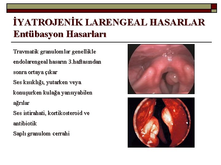 İYATROJENİK LARENGEAL HASARLAR Entübasyon Hasarları Travmatik granulomlar genellikle endolarengeal hasarın 3. haftasından sonra ortaya