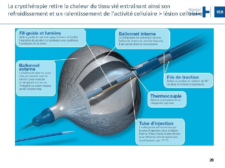 La cryothérapie retire la chaleur du tissu vié entraînant ainsi son refroidissement et un