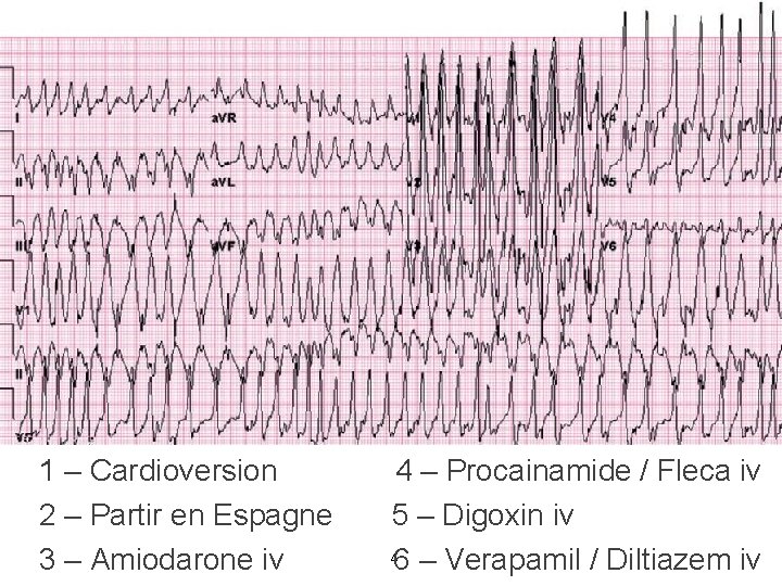 1 – Cardioversion 2 – Partir en Espagne 3 – Amiodarone iv 4 –