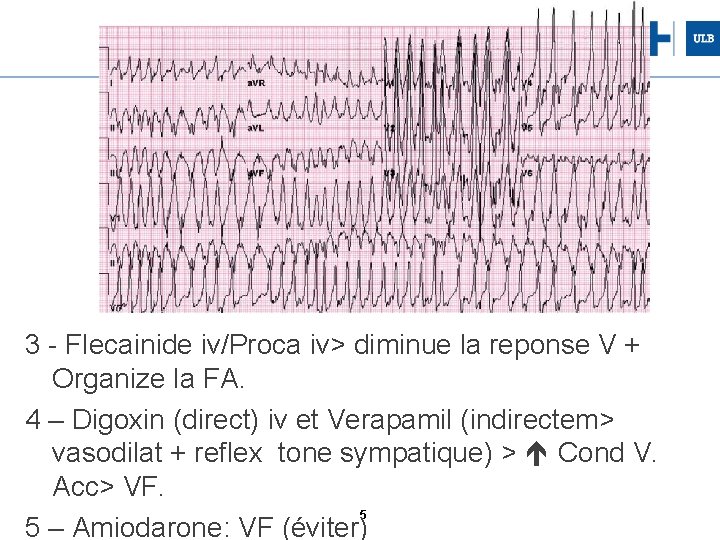 3 - Flecainide iv/Proca iv> diminue la reponse V + Organize la FA. 4