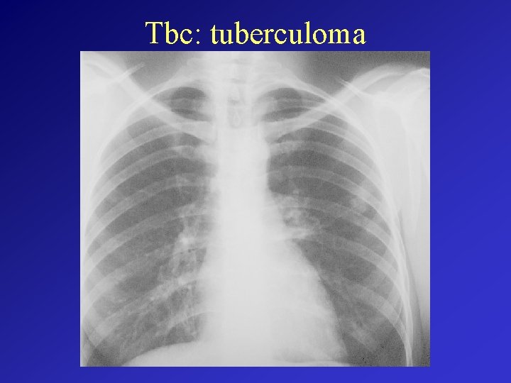 Tbc: tuberculoma 