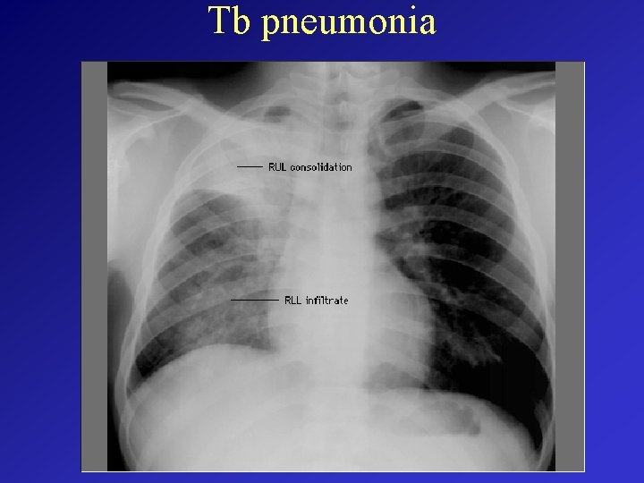 Tb pneumonia 