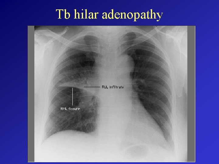 Tb hilar adenopathy 