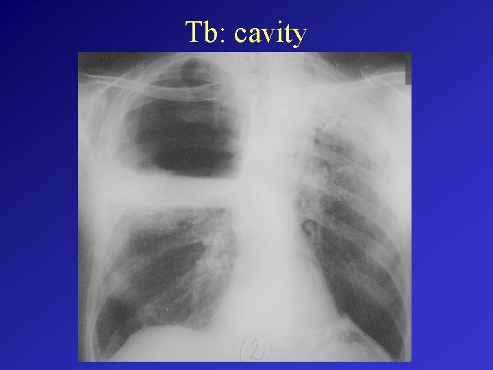 Tb: cavity 