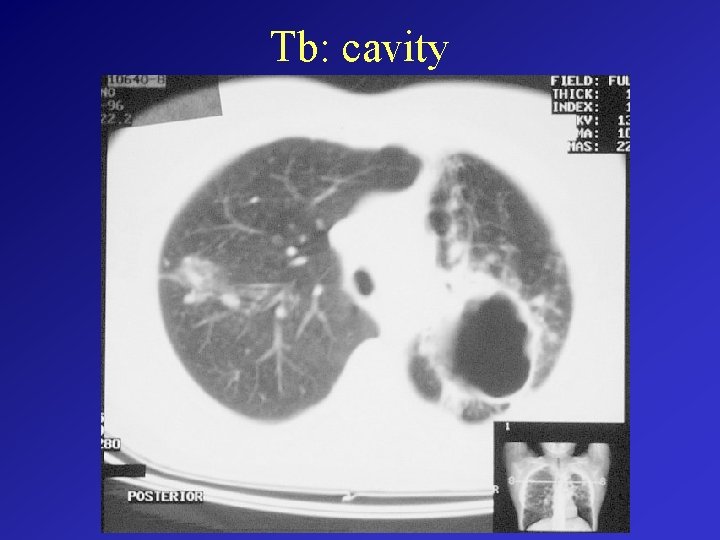 Tb: cavity 