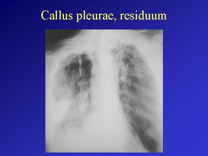 Callus pleurae, residuum 