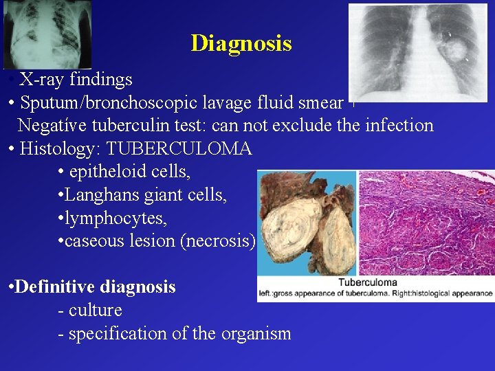 Diagnosis • X-ray findings • Sputum/bronchoscopic lavage fluid smear + Negatíve tuberculin test: can