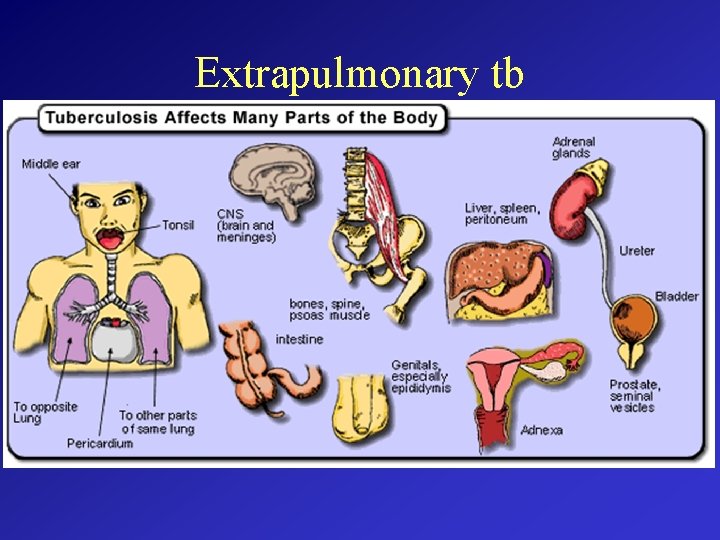 Extrapulmonary tb 