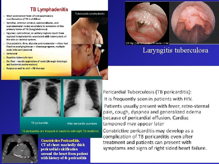 Laryngitis tuberculosa Constrictive Pericarditis. CT of chest: markedly thick pericardial calcification around the heart