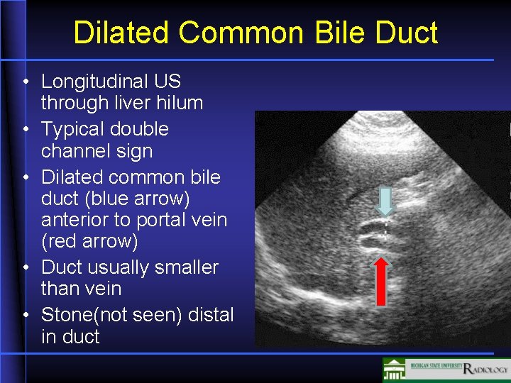 Dilated Common Bile Duct • Longitudinal US through liver hilum • Typical double channel