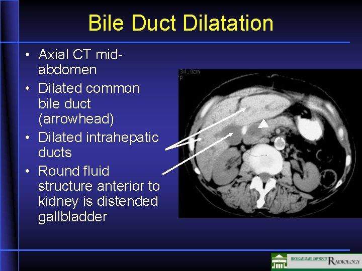 Bile Duct Dilatation • Axial CT midabdomen • Dilated common bile duct (arrowhead) •