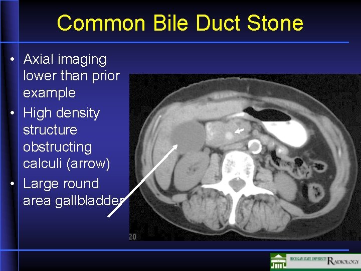 Common Bile Duct Stone • Axial imaging lower than prior example • High density
