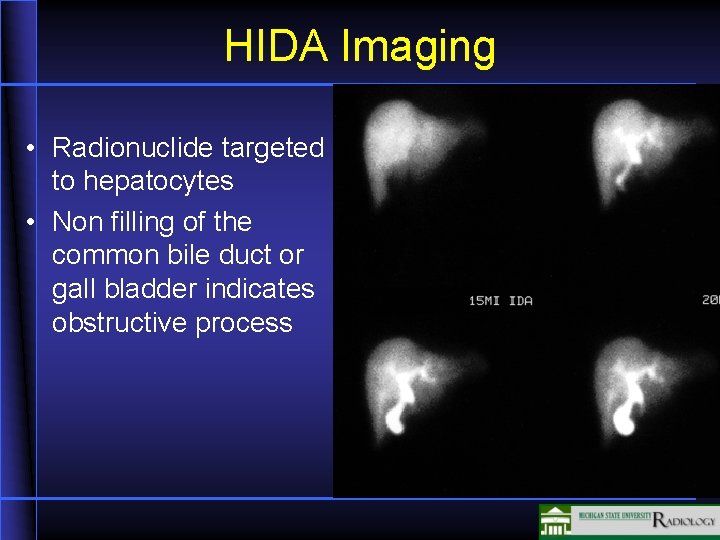 HIDA Imaging • Radionuclide targeted to hepatocytes • Non filling of the common bile