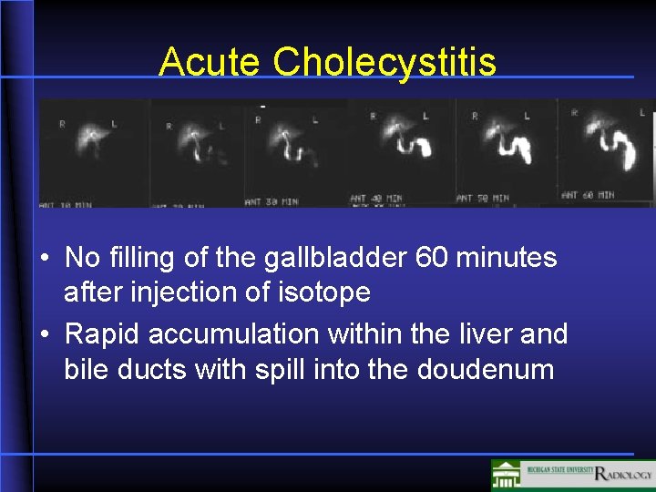 Acute Cholecystitis • No filling of the gallbladder 60 minutes after injection of isotope