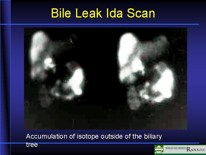 Bile Leak Ida Scan Accumulation of isotope outside of the biliary tree 