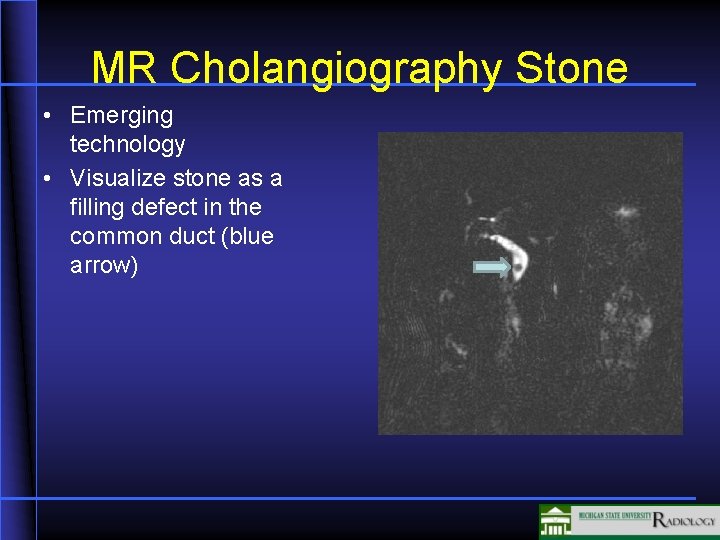 MR Cholangiography Stone • Emerging technology • Visualize stone as a filling defect in