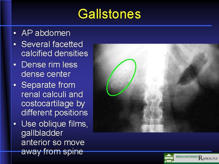 Gallstones • AP abdomen • Several facetted calcified densities • Dense rim less dense