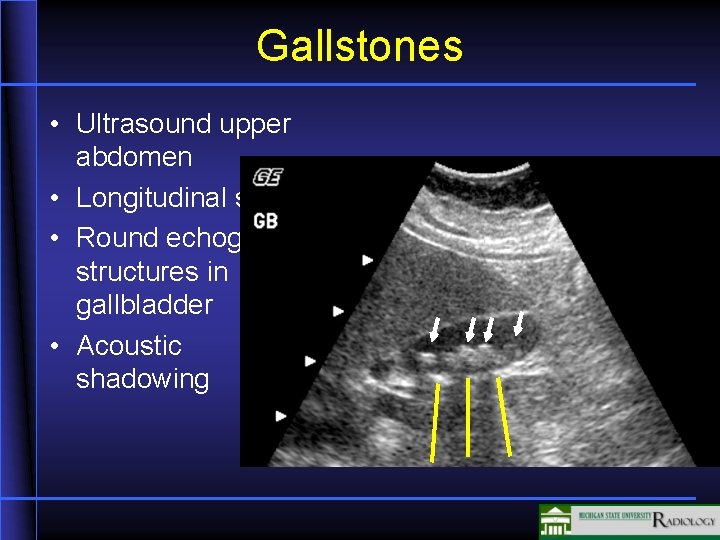 Gallstones • Ultrasound upper abdomen • Longitudinal scan • Round echogenic structures in gallbladder