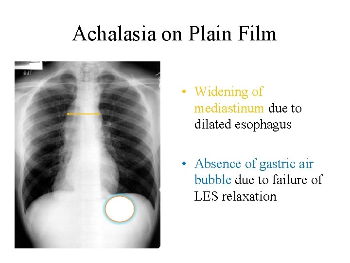 Achalasia on Plain Film • Widening of mediastinum due to dilated esophagus • Absence