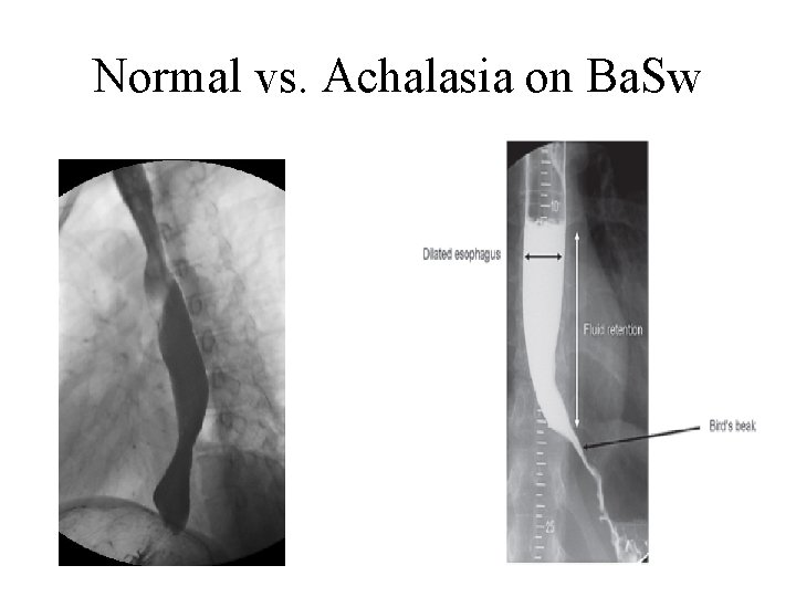 Normal vs. Achalasia on Ba. Sw 