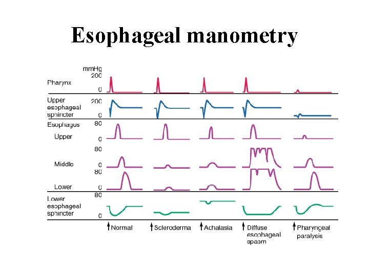 Esophageal manometry 