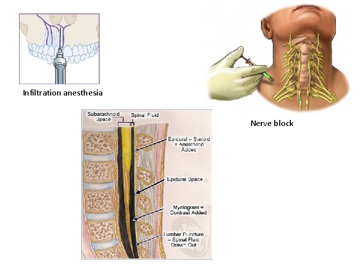 Infiltration anesthesia Nerve block 