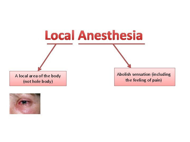 Local Anesthesia A local area of the body (not hole body) Abolish sensation (including