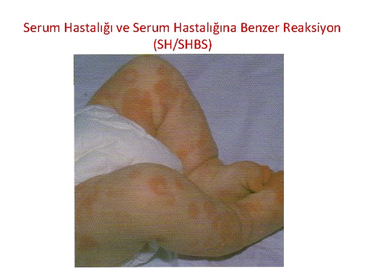 Serum Hastalığı ve Serum Hastalığına Benzer Reaksiyon (SH/SHBS) 