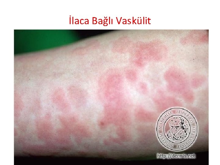 İlaca Bağlı Vaskülit 