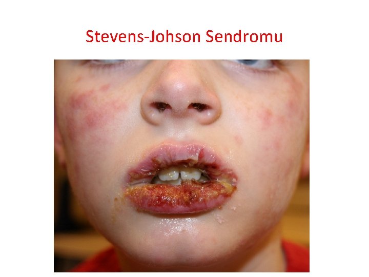 Stevens-Johson Sendromu 