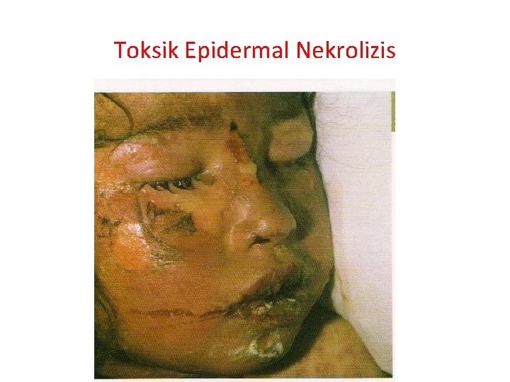 Toksik Epidermal Nekrolizis 