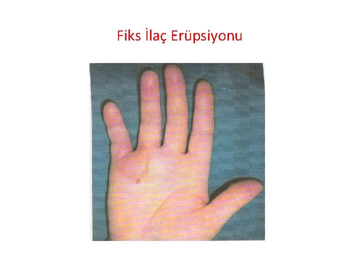 Fiks İlaç Erüpsiyonu 